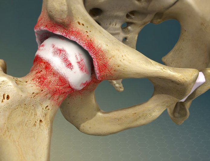 Degenerative joint disease - Arthritis